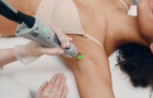 Epilation Laser
