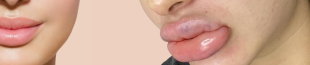 lèvres mal injectées
