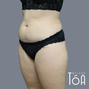Coolsculpting - Non-Surgical Fat Reduction 2 5 1 01a2ca79
