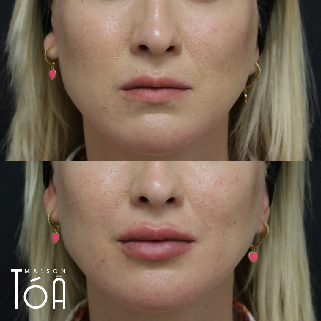 Acide Hyaluronique 2 acide hyaluronique lèvres visage