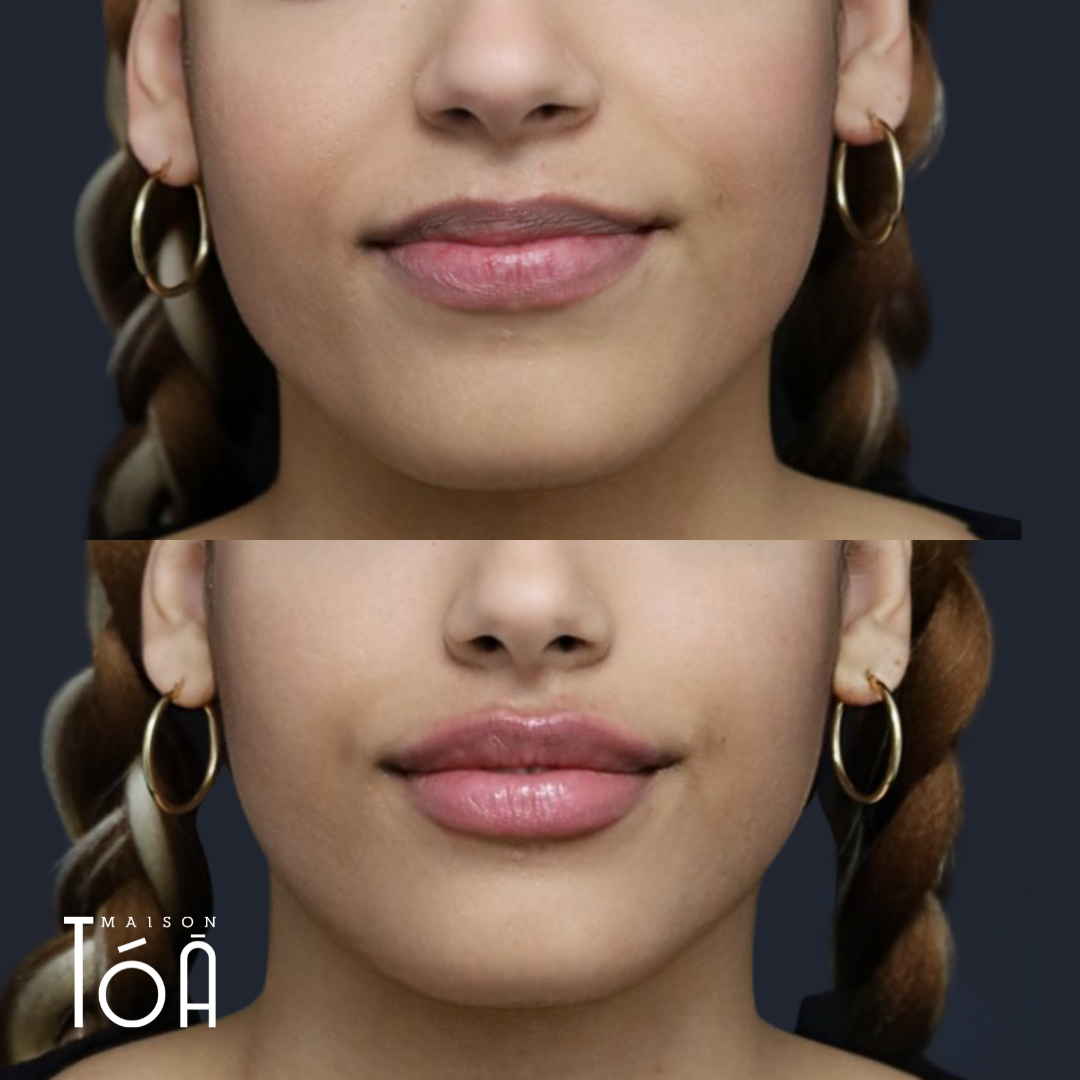 Offre 6 injections lèvres