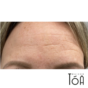Microneedling - Skin Rejuvenation and Scar Treatment 4 micrnoeedling 3 12621289
