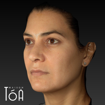 Melasma 3 4 2 17afcdd1