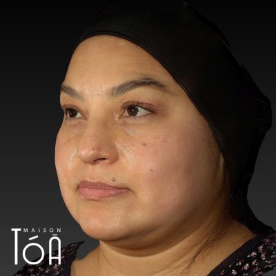 Melasma 1 2 6 320358a0