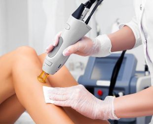 epilation laser