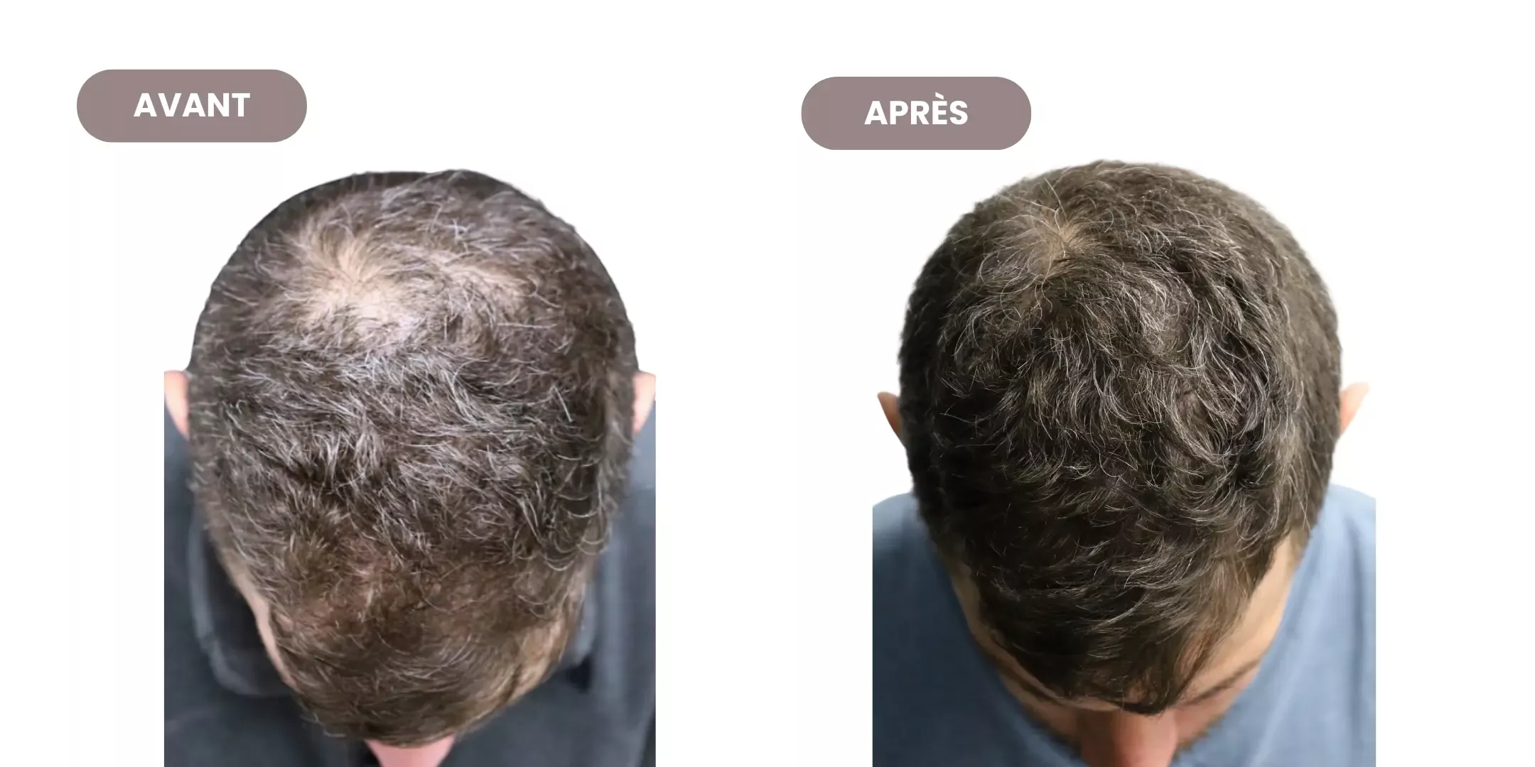 Injections PRP cheveux homme 12 prp