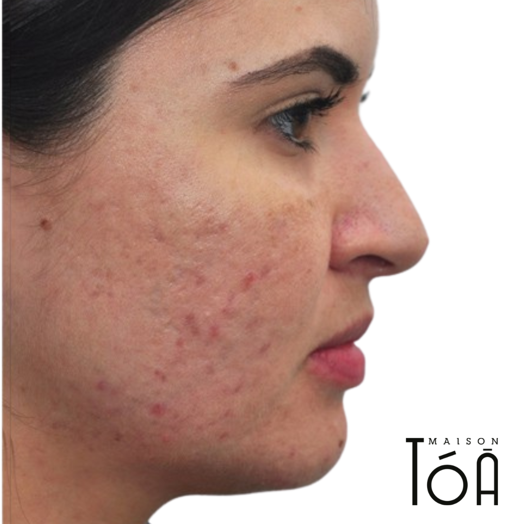 microneedling