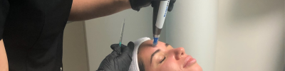 Microneedling 577136ed