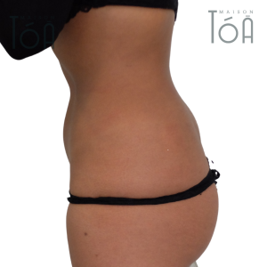 Liposuction 4 6 5bddad6d