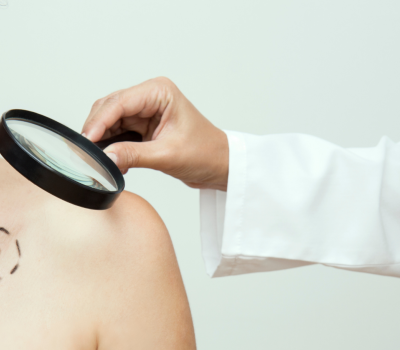 Excision des cancers cutanés