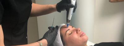 Microneedling