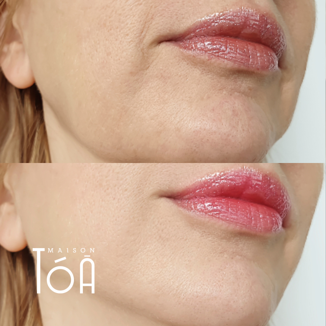 Skinbooster avant apres 