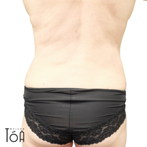 Liposuction 1 7 6d6b1f07