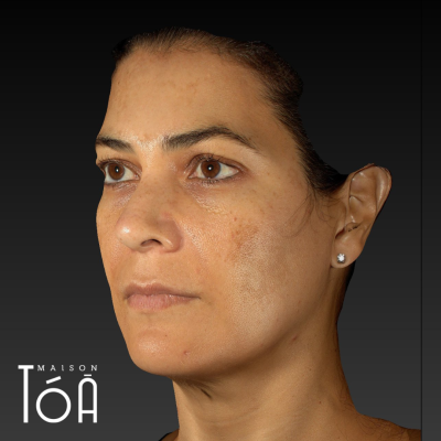 Melasma 4 3 3 72fcfbb7