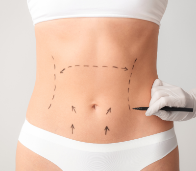 abdominoplatie 7889ca07