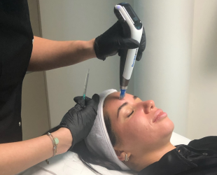 Microneedling