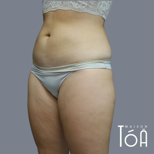 Coolsculpting - Non-Surgical Fat Reduction 1 4 6 8dcba8a7