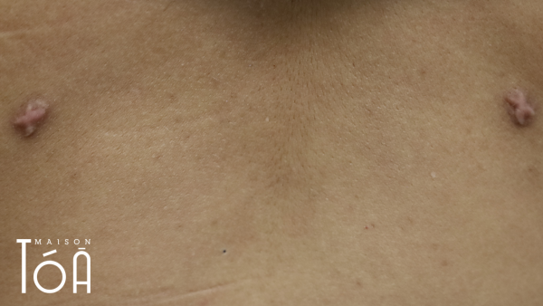 Treatment of scars 4 4 1 94ef0357