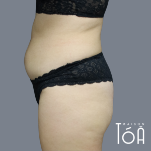 Coolsculpting - Non-Surgical Fat Reduction 4 2 10 9b801edd