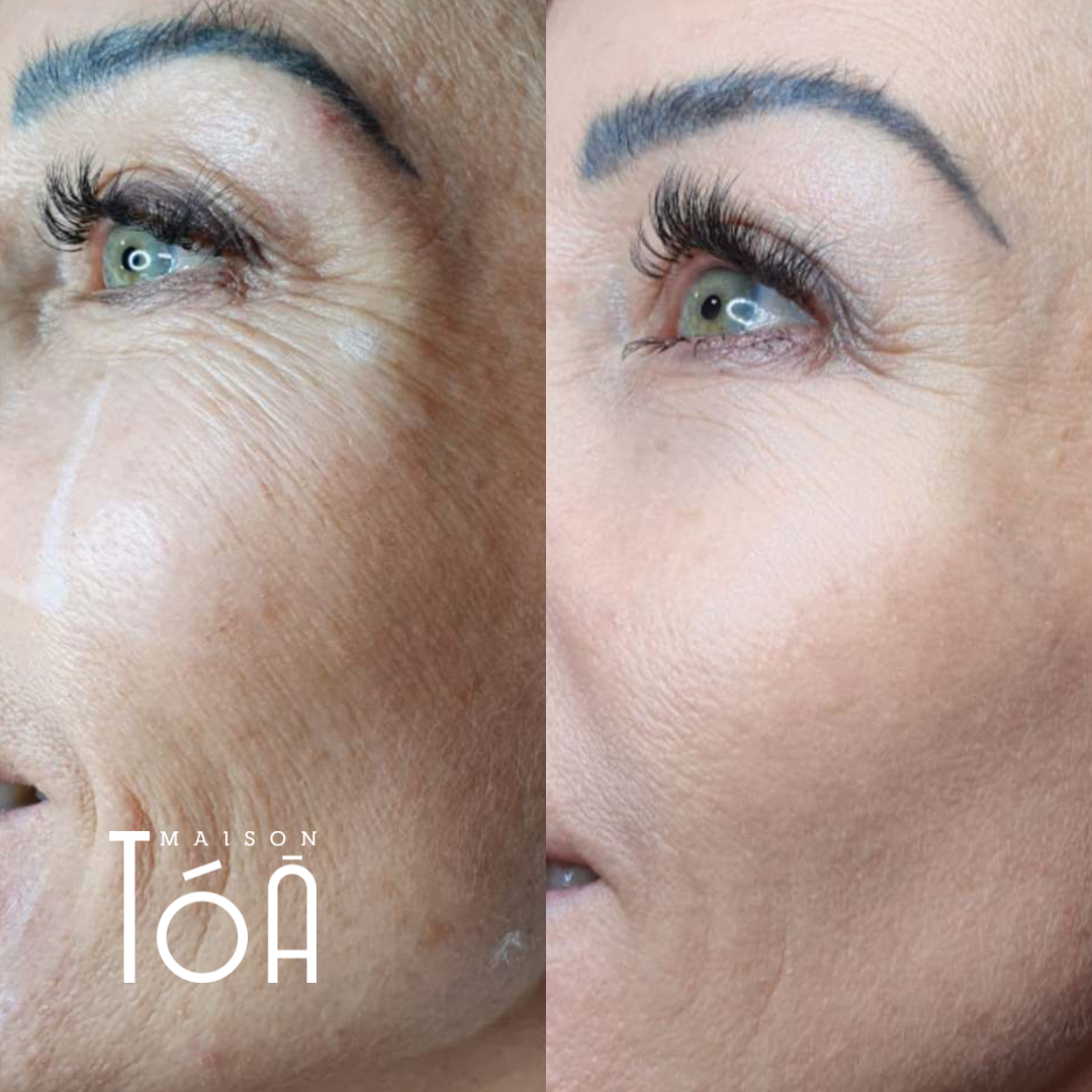Skinbooster avant apres