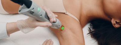 Epilation Laser