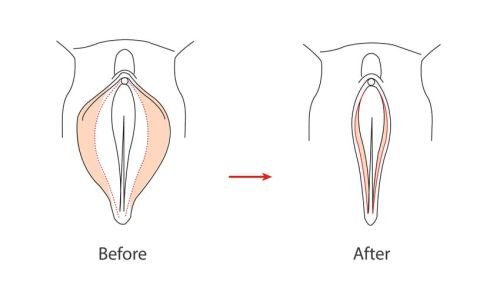 Chirurgie intime – Nymphoplastie 1 nymphoplastie avant apres