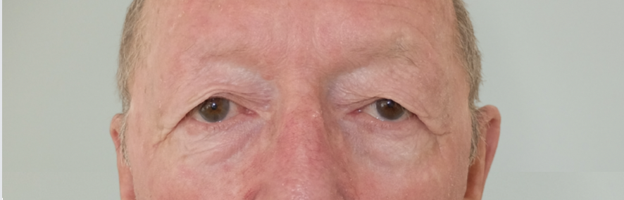 blépharoplastie avant après