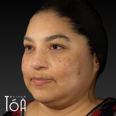 Melasma 2 1 5 dc5336c7