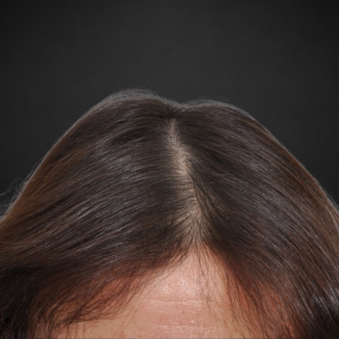 prp hair loss