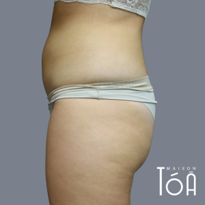Coolsculpting - Non-Surgical Fat Reduction 3 1 7 f4a732d6