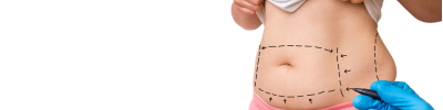 mini abdominoplastie