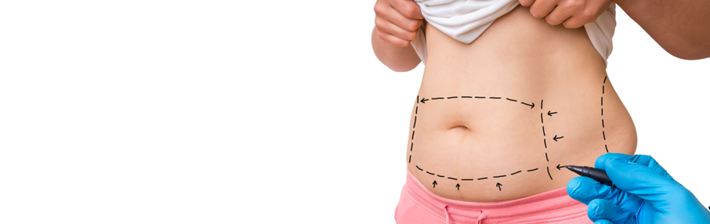 mini abdominoplastie