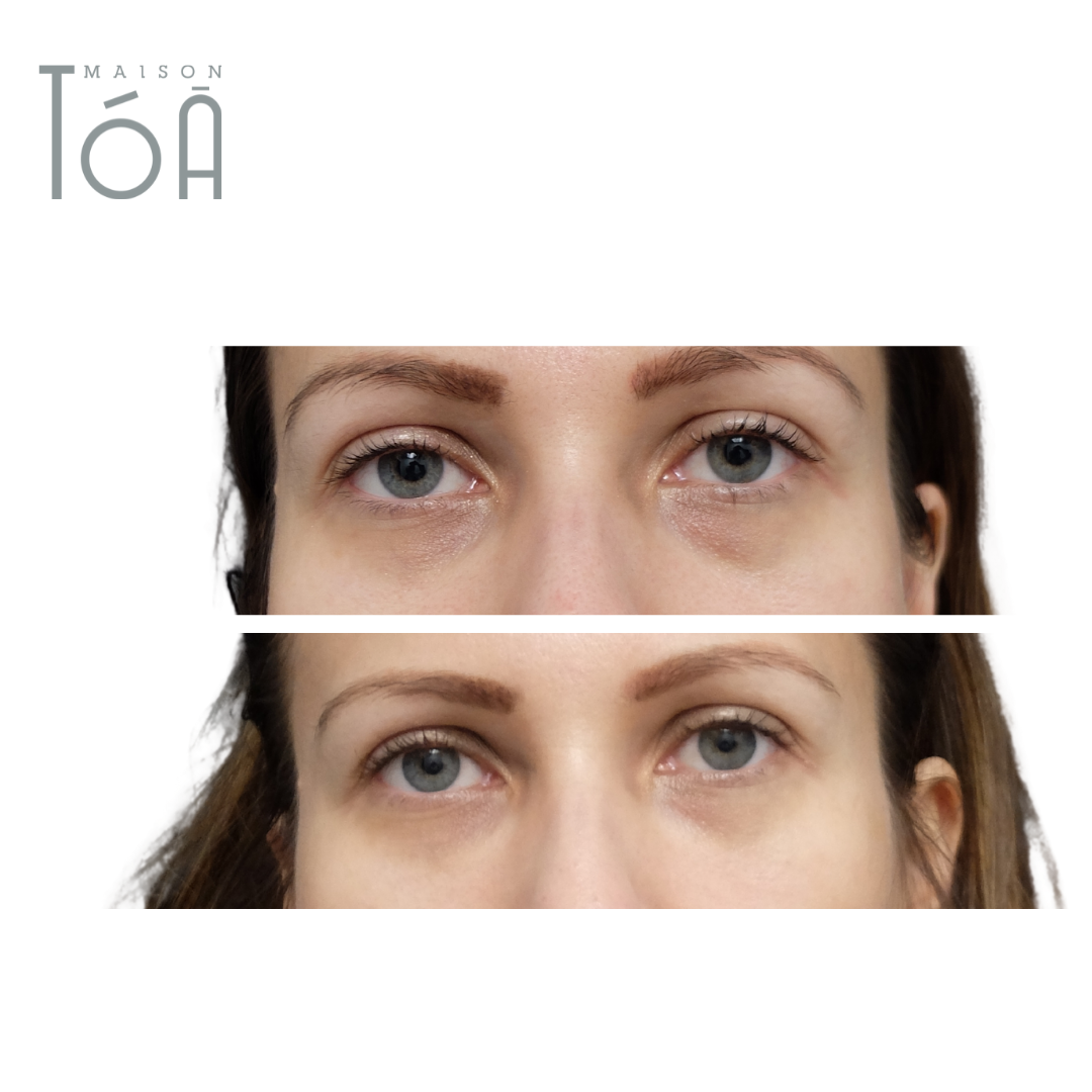 Acide Hyaluronique pour les yeux : Solution pour cernes et regard fatigué 10 acide hyaluronique yeux