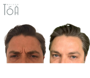 Injection botox lausanne