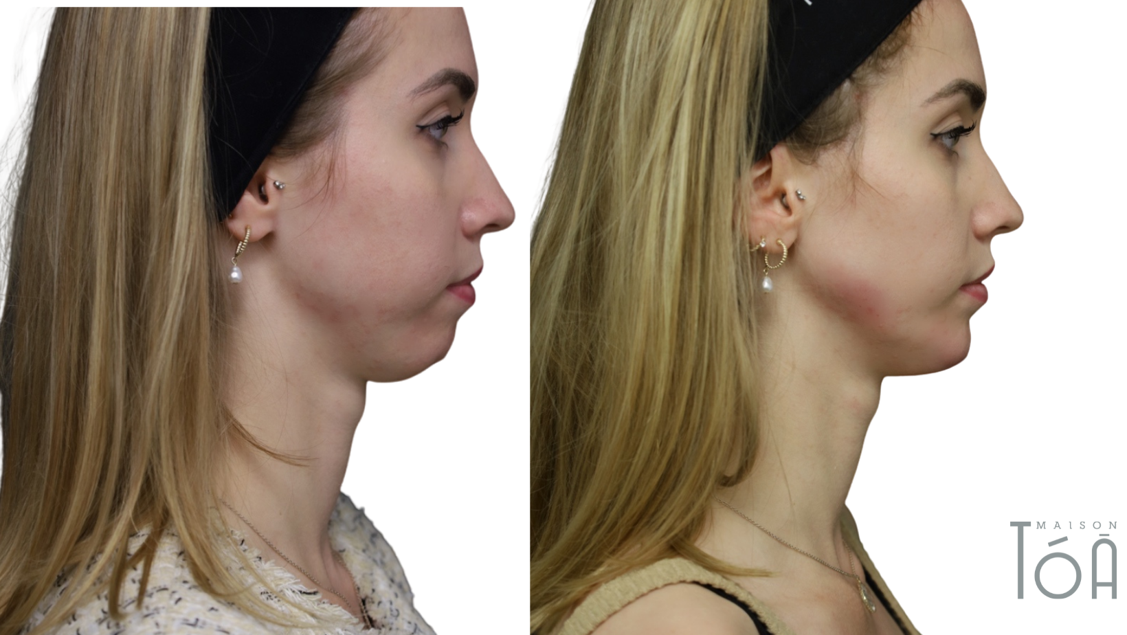 Injection Acide Hyaluronique Jawline 6 injection jawline avant apres