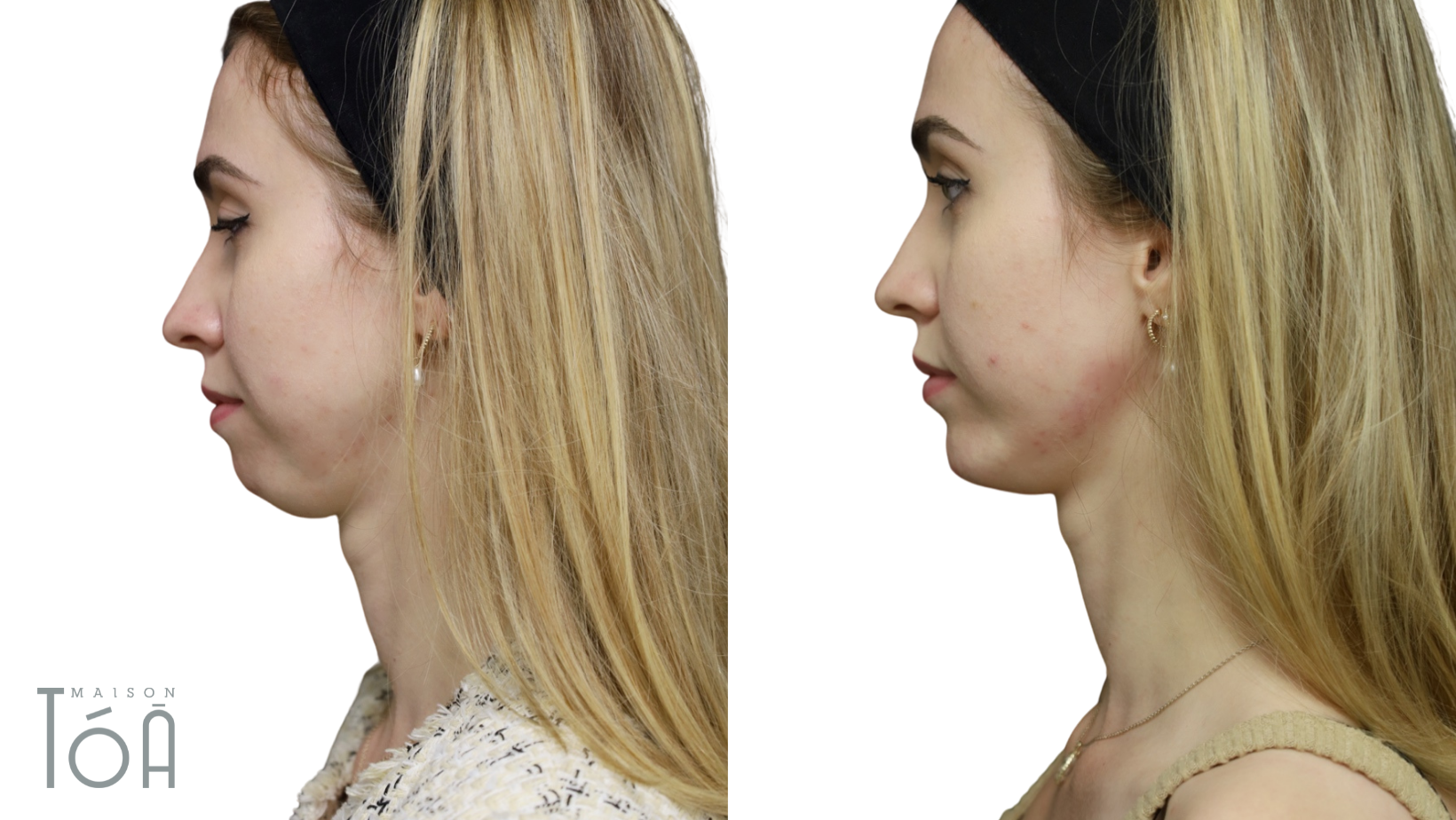 Injection Acide Hyaluronique Jawline 5 injection jawline avant apres