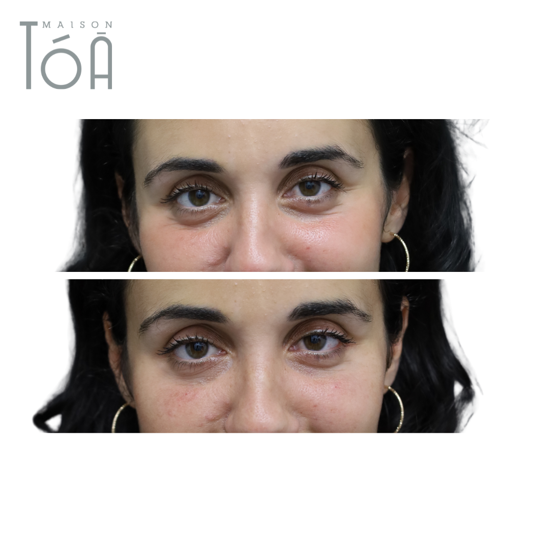 Acide Hyaluronique pour les yeux : Solution pour cernes et regard fatigué 9 acide hyaluronique yeux