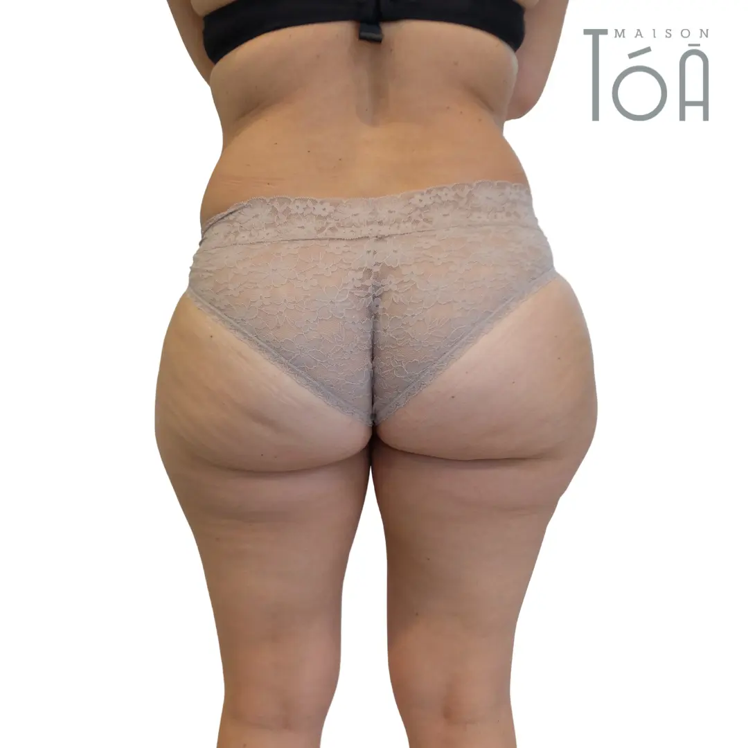 liposuccion