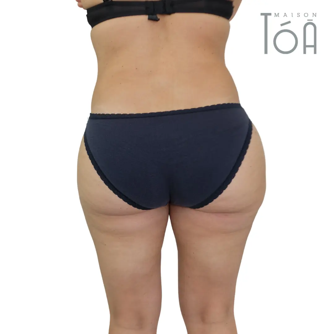 liposuccion lausanne