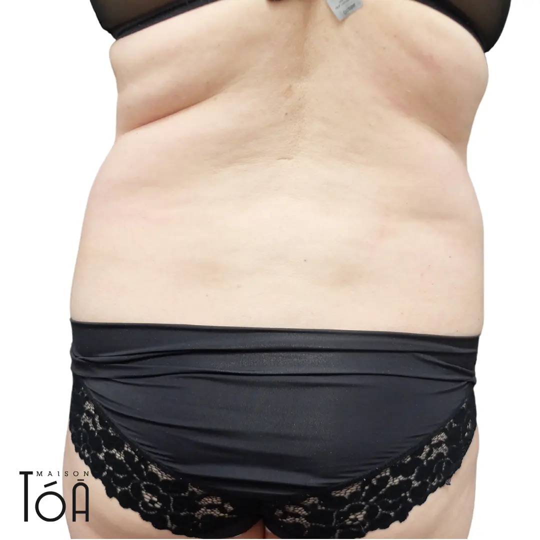 liposuccion lausanne