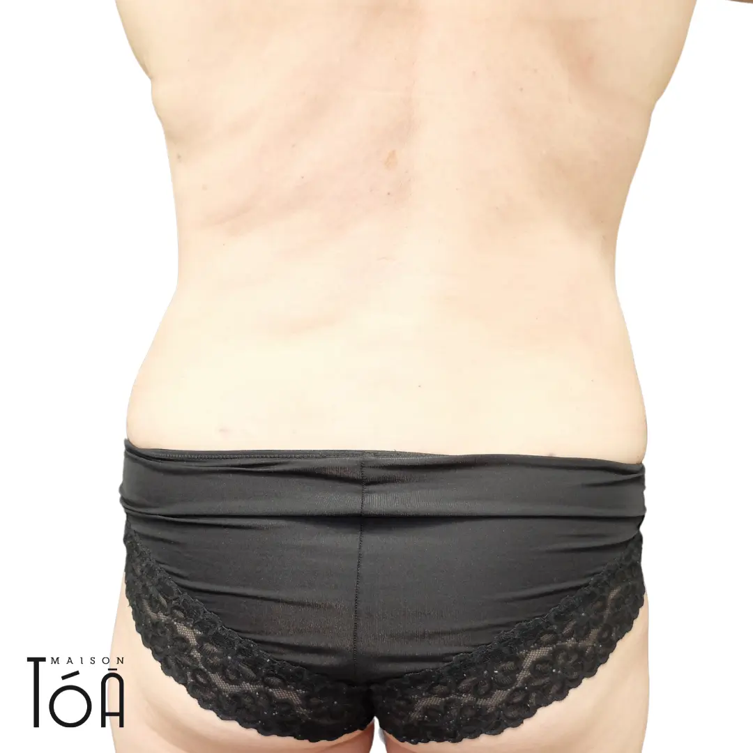 liposuccion lausanne