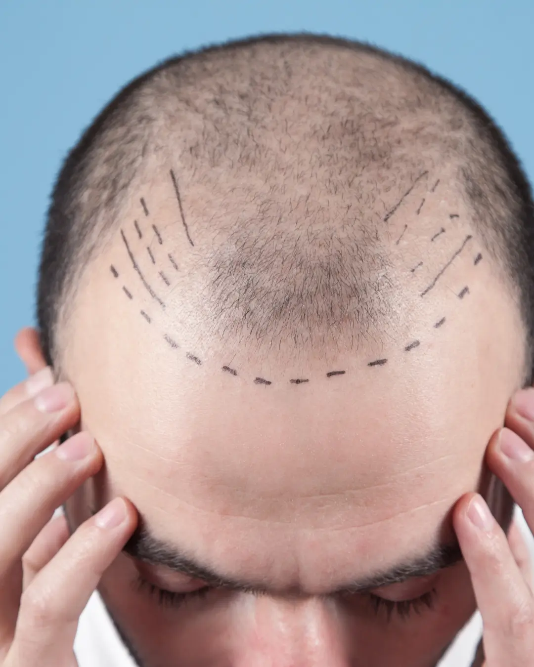 Injections PRP cheveux homme 11 greffe de cheveux