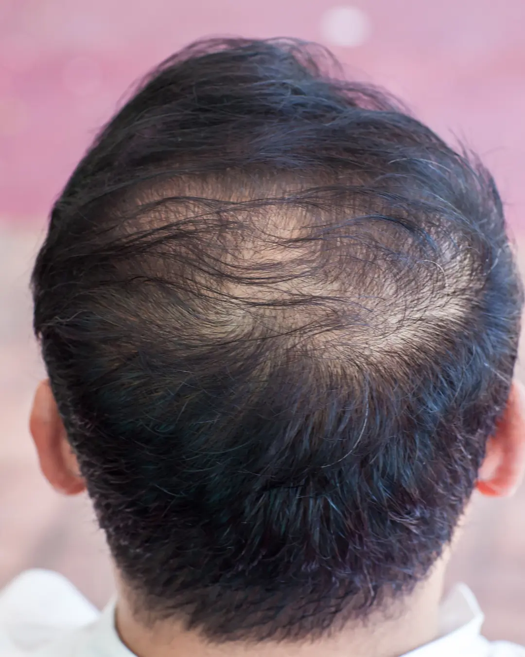 Injections PRP cheveux homme 10 cheveux clairessemé