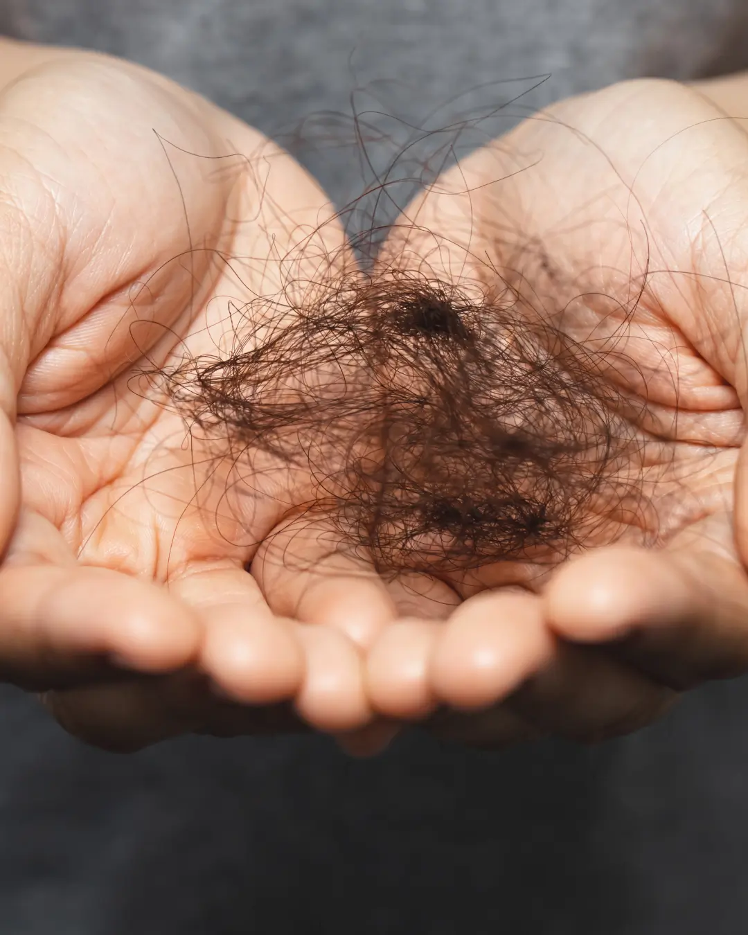 Injections PRP cheveux homme 9 cheveux fragiles