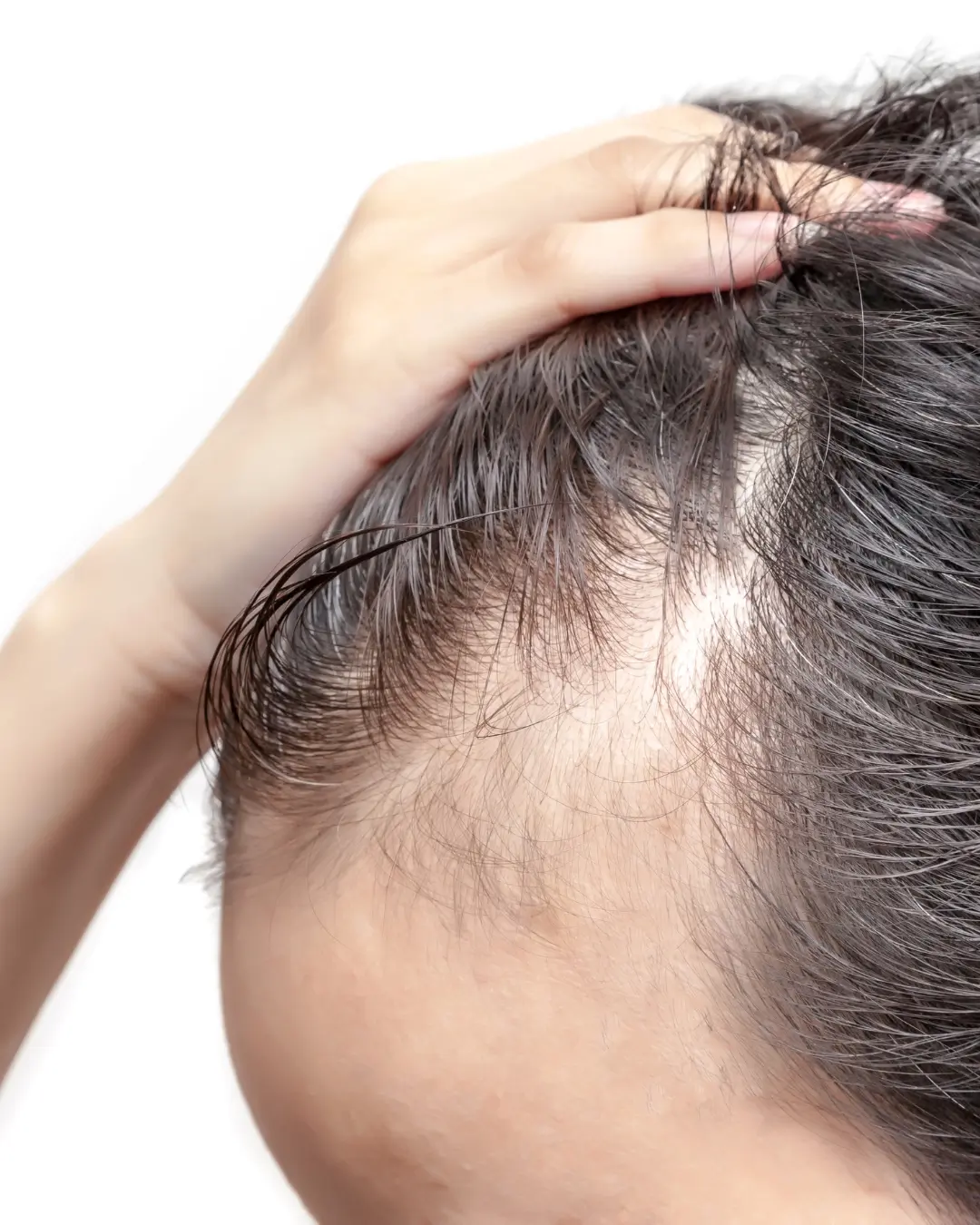 Injections PRP cheveux homme 8 chute de cheveux