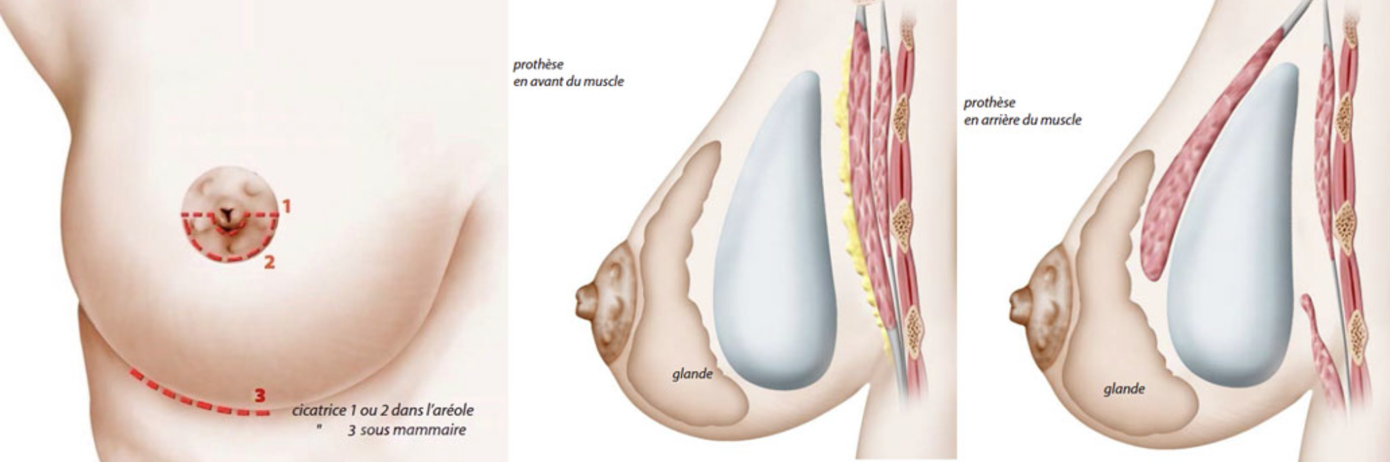 augmentation mammaire derrière le muscle