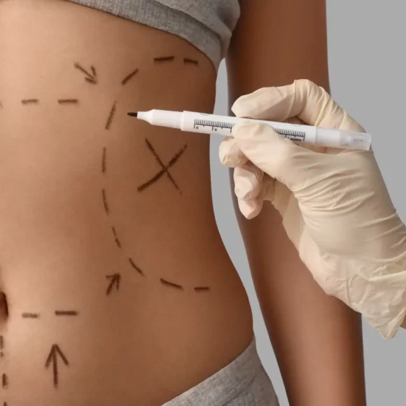 liposuccion lausanne e1769332491326