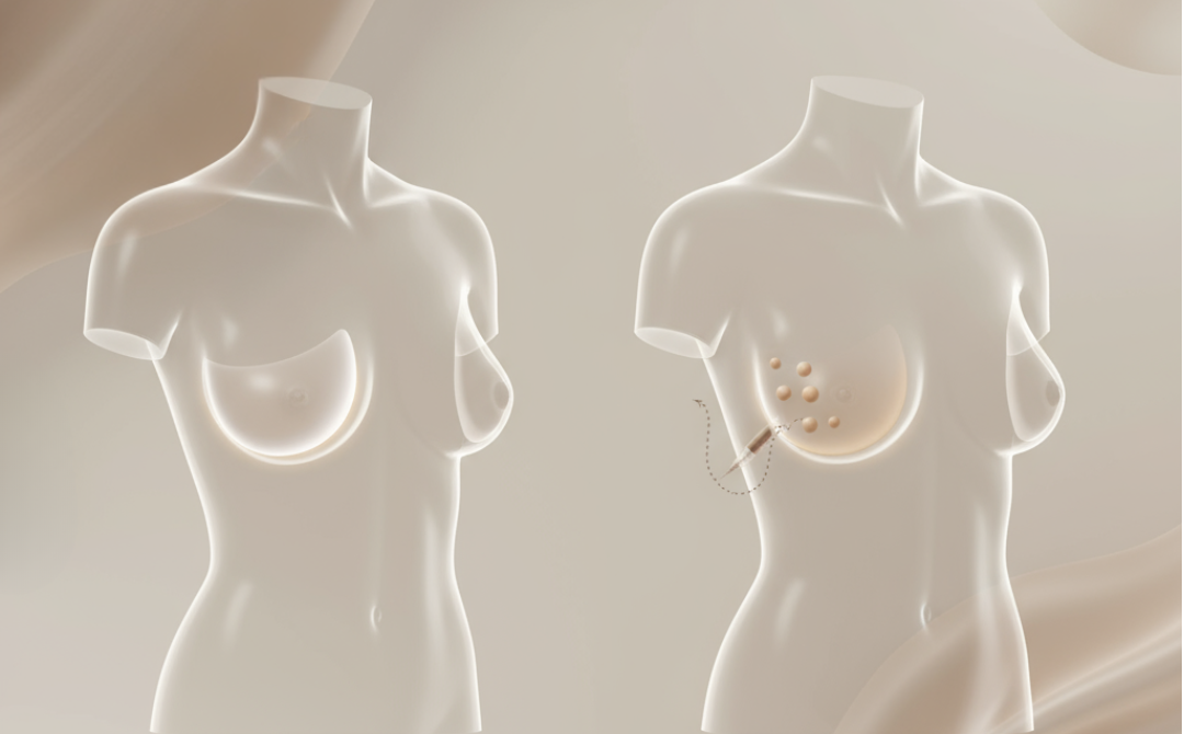 augmentation mammaire lausanne