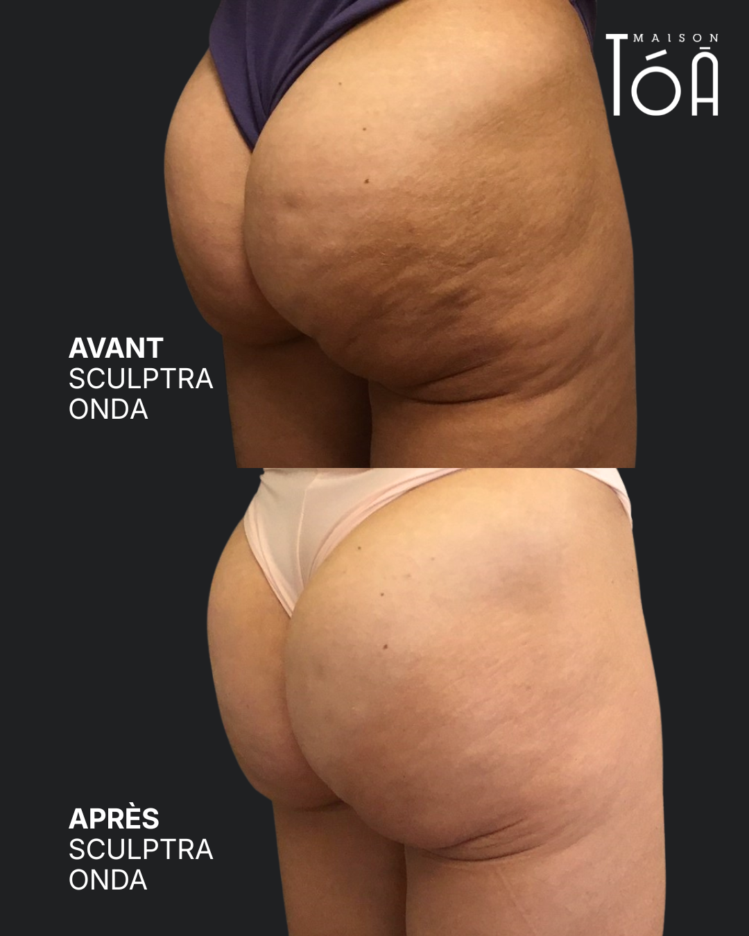 Avant Apres fessiers 2