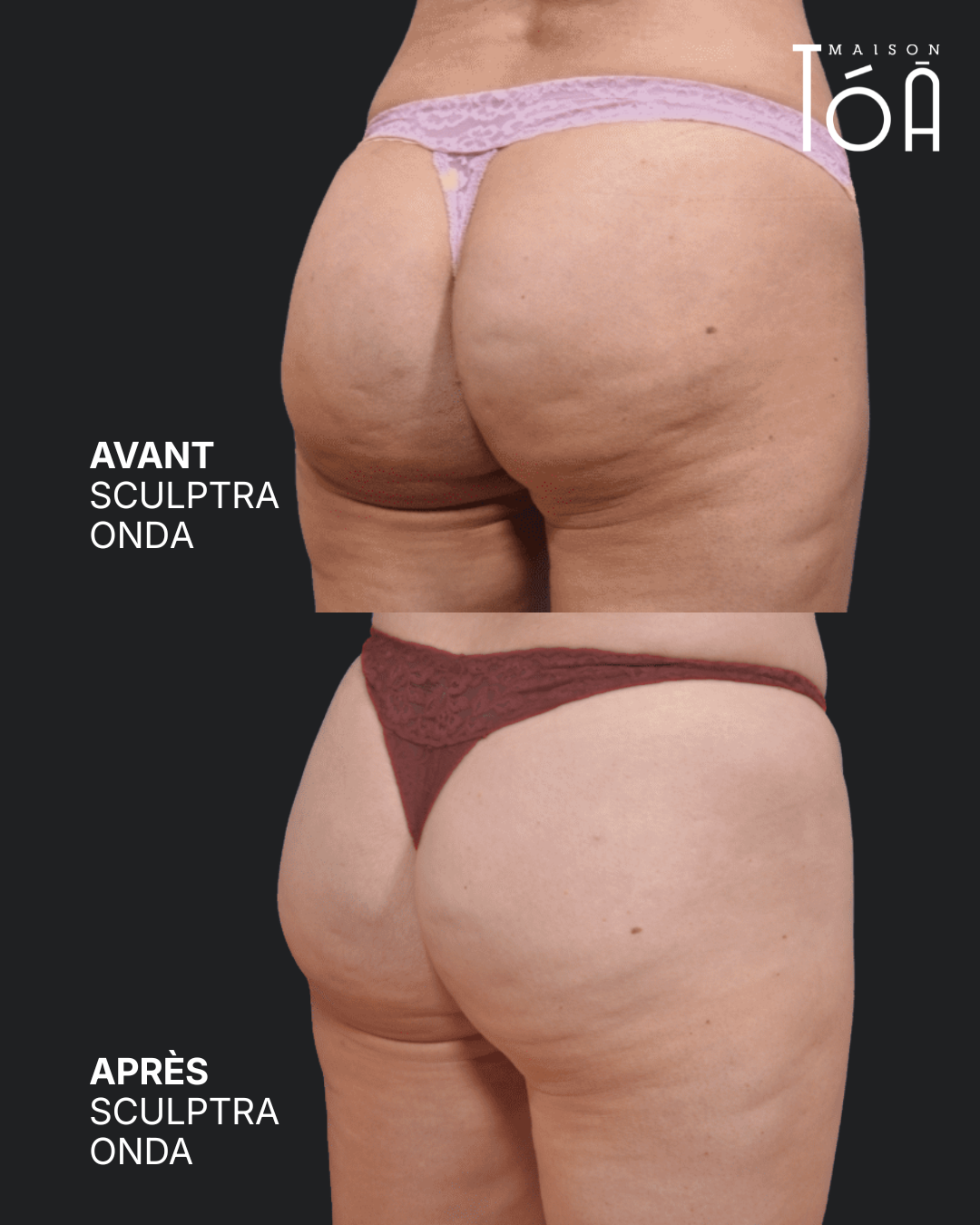 Avant Apres fessiers